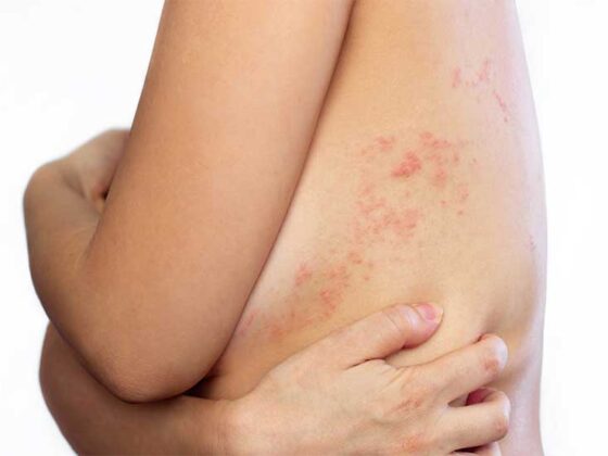 Zona zoster este cauzata de acelasi virus responsabil de varicela. Dureaza in general 1-2 saptamani, doar ca virusul poate ramane in corp pentru mult timp,