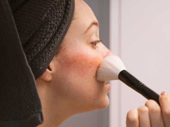Rozaceea apare in mod deosebit in cazul femeilor care pot dezvolta această boală sau o pot accentua când sunt pe cale să dea naştere copiilor, când se apropie menopauza; cu toate acestea, cauza exactă nu este necunoscută.